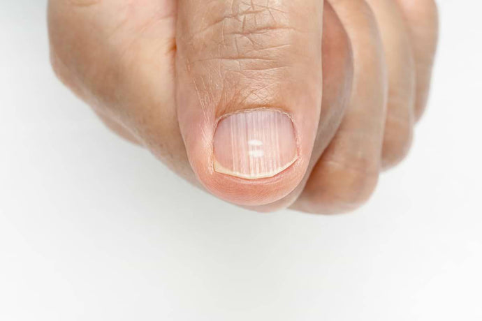 Weiße Flecken auf den Fingernägeln – Ursache und Lösung